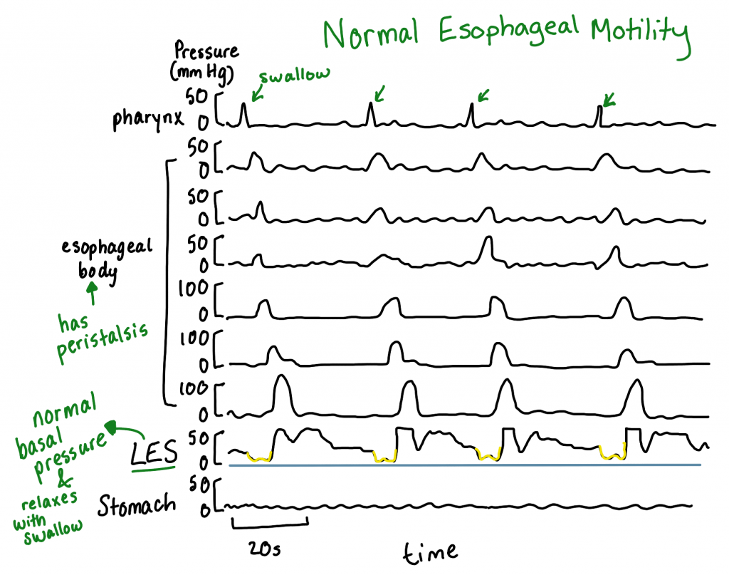 Normal esophageal manometry