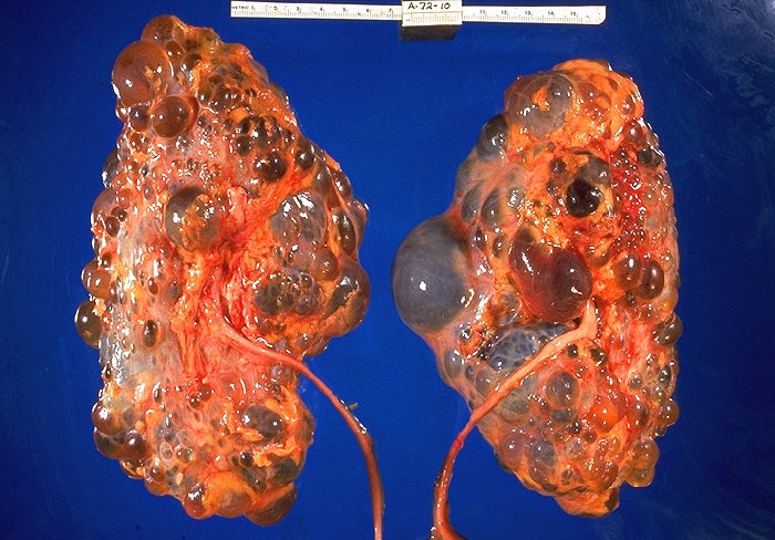 Cystic kidneys